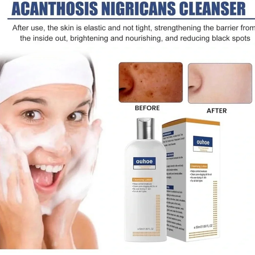 NWT‎ Acne and Spots Cleansing Lotion Relief 50ml for Dry Skin Facial Cleanser